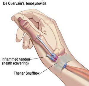 tenosynovitis finger