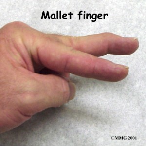 Mallet Finger