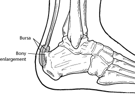 Haglund Foot Deformity Specialist Singapore Sports And Orthopaedic Clinic Neurosurgeon