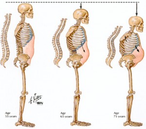 Osteoporosis and Aging