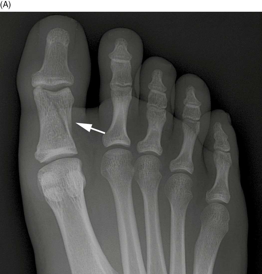 Top of foot hairline fracture - Lasiwhole